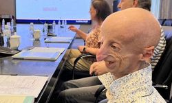 En uzun yaşayan progeria hastası, 28 yaşında hayatını kaybetti!