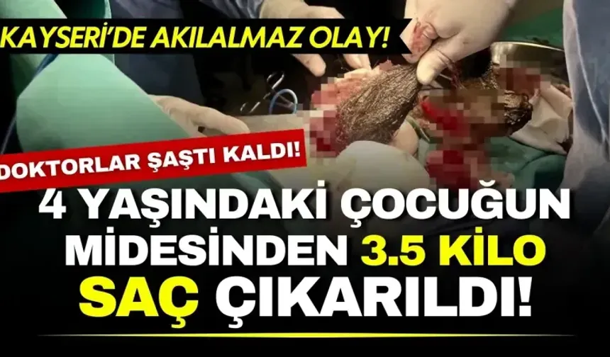 Doktorlar şaştı kaldı! 14 yaşındaki çocuğun midesinden 3.5 kilo saç çıkarıldı!